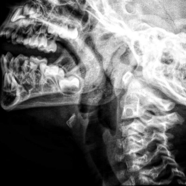 Radiografía de cuello: procedimiento y usos