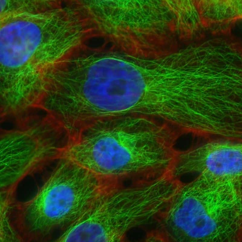 Síndrome de cáncer hereditario: causas, síntomas y tratamiento.