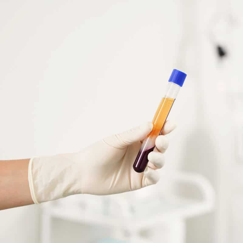 Servicio de plasma rico en plaquetas (PRP), en VIVO SAGASTA.