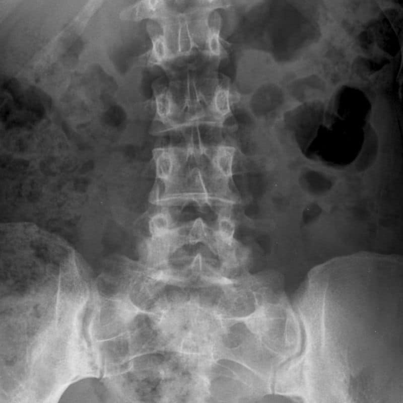 Prueba de rayos X para el intestino: todo lo que debes saber.