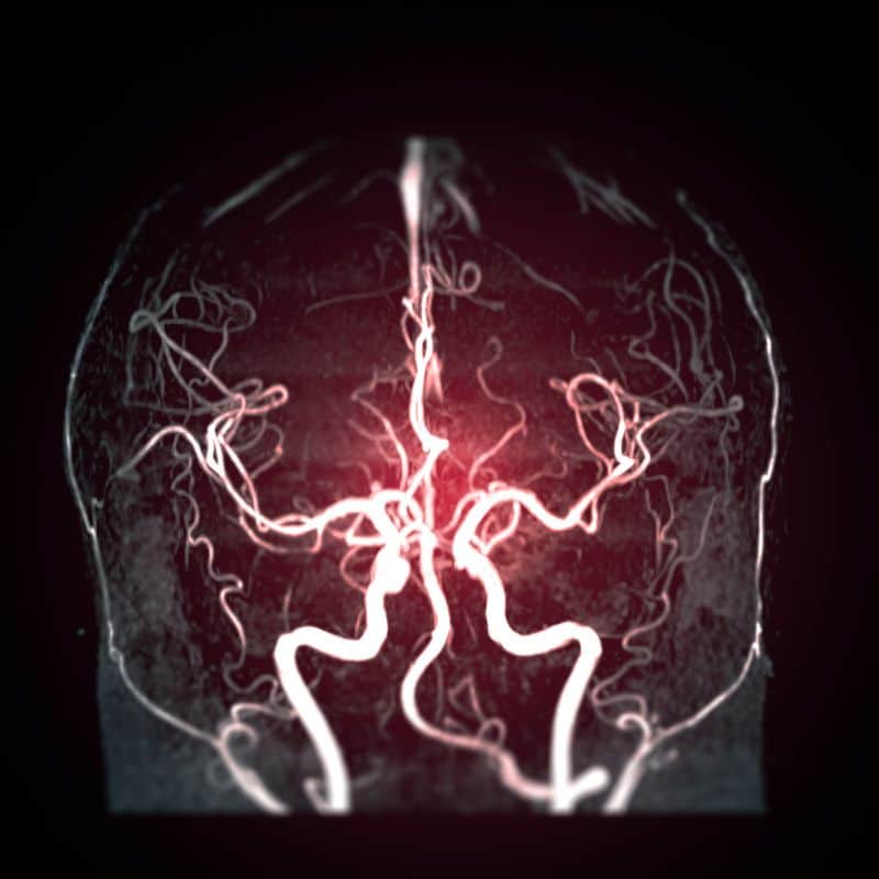 Resonancia de cráneo sin contraste: lo que debes saber.