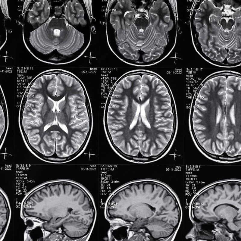 Requisitos para realizar una resonancia magnética de cráneo, en MIDIAGNOSTICO.